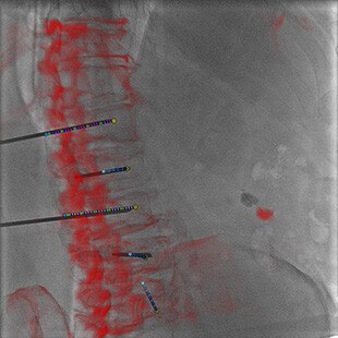 product-product-categories-Intervantional - 2016-needle_12.jpg